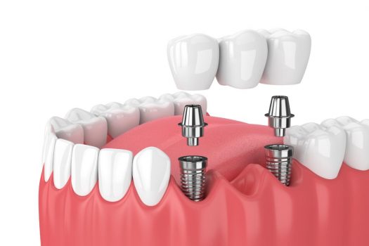 How-Do-Dental-Implants-Work
